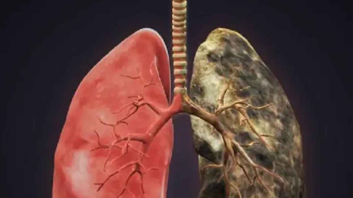 lungs cancer