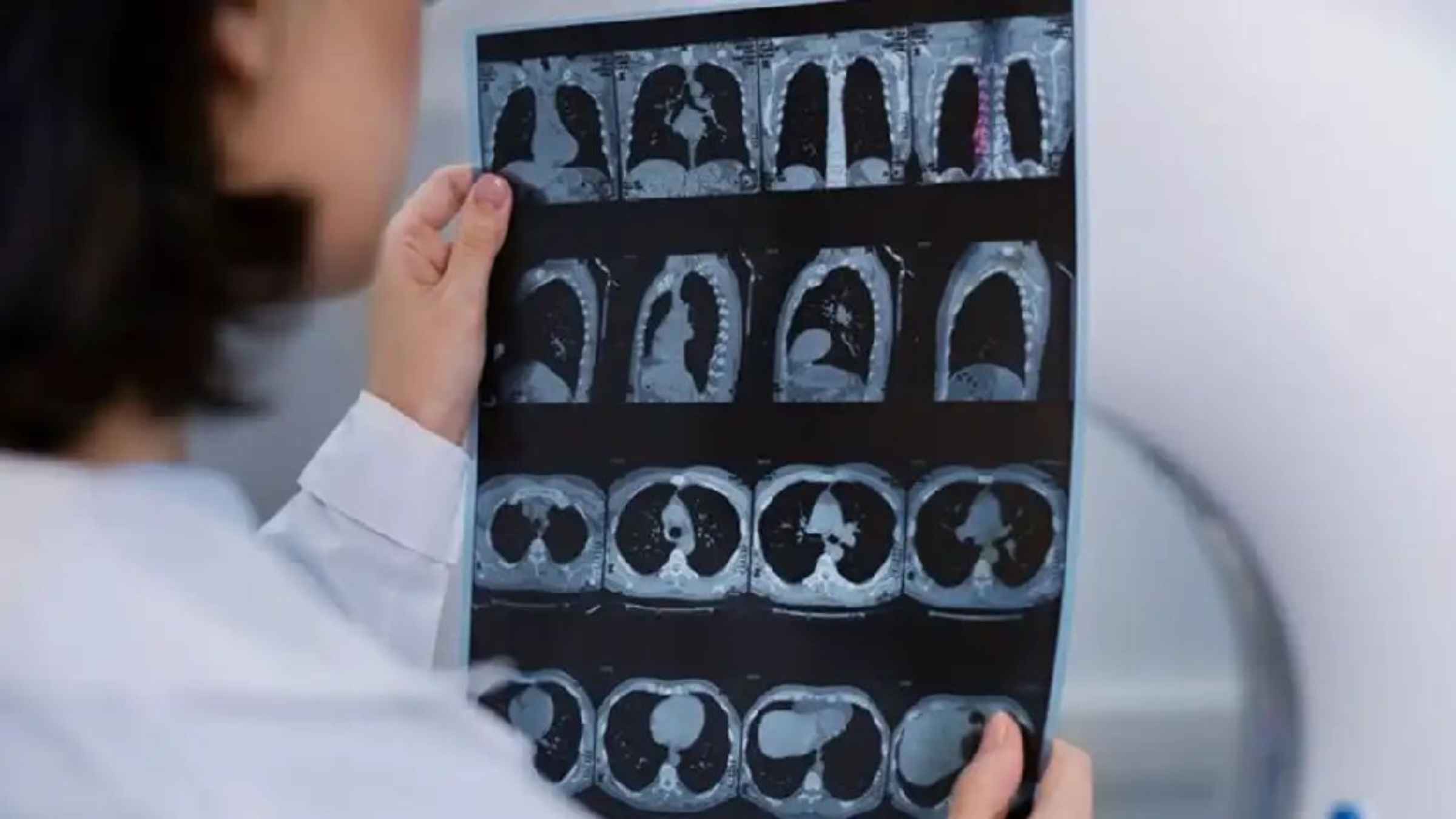 क्या X-Ray और CT Scan की रेडिएशन वाकई जानलेवा है? एक्सपर्ट से जानिए इसके पीछे का कड़वा सच CT Scan Radiation