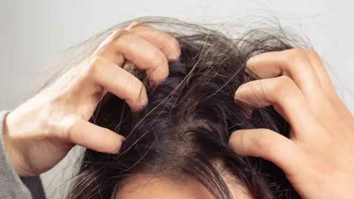 गर्मी के मौसम में सिर की खुजली से आ गया है रोना? डैंड्रफ और इन्फेक्शन से बचने के लिए आजमाएं ये टिप्स HairCare