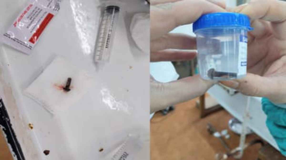 शिमला IGMC के डॉक्टरों का कमाल: युवक के फेफड़े में 3 साल से फंसा था लोहे का पेंच, ब्रोंकोस्कोपी से 7 मिनट में निकाला The young man had a screw stuck in his lung for three years.