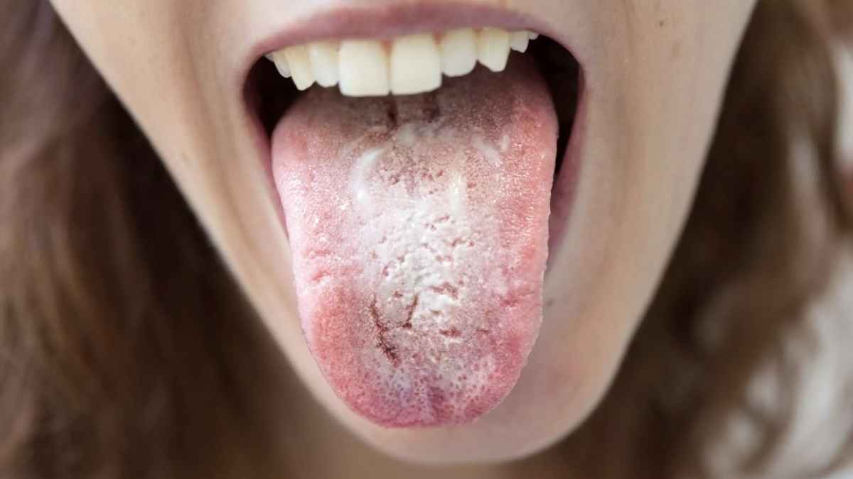 oral cancer