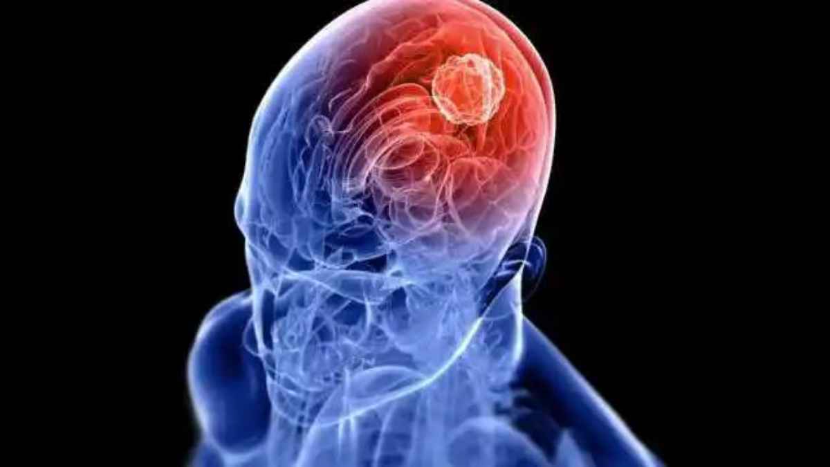 क्या खान-पान से है ब्रेन ट्यूमर का कनेक्शन? जानिए किन चीजों से दूरी बनाना है बेहद जरूरी brain-tumor