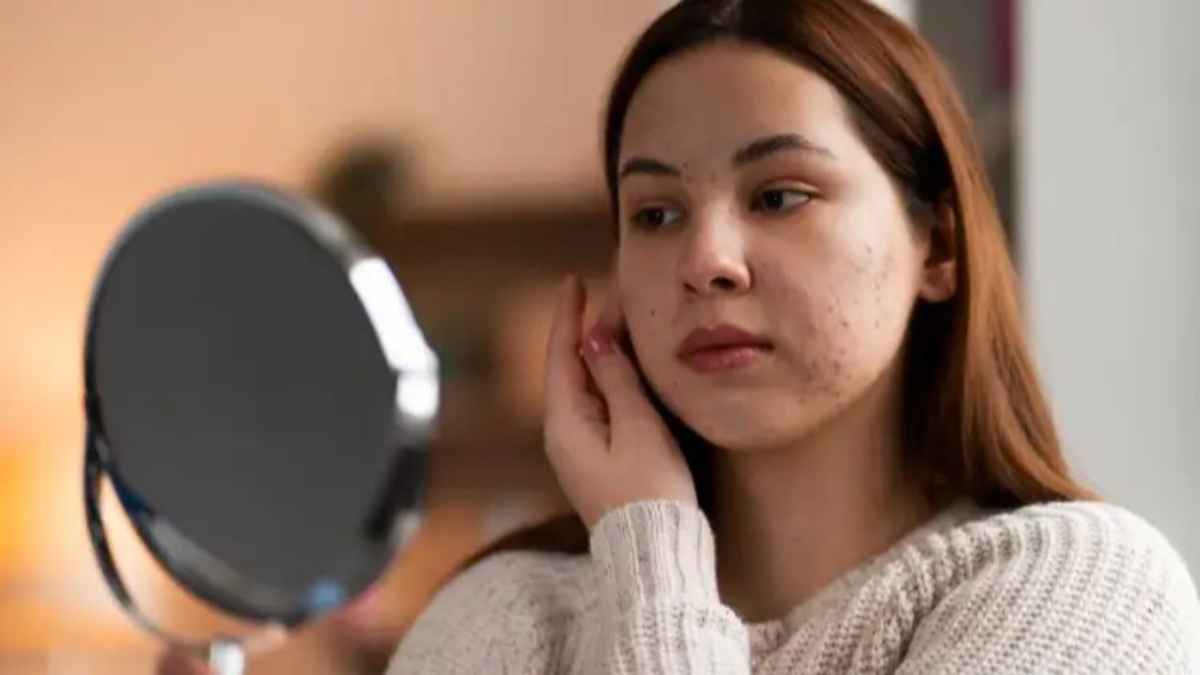 क्या आपके चेहरे के काले धब्बे सिर्फ टैनिंग नहीं, कोई गंभीर समस्या हैं? जानिए पिग्मेंटेशन के 5 छिपे हुए कारण dark-spots-on-face