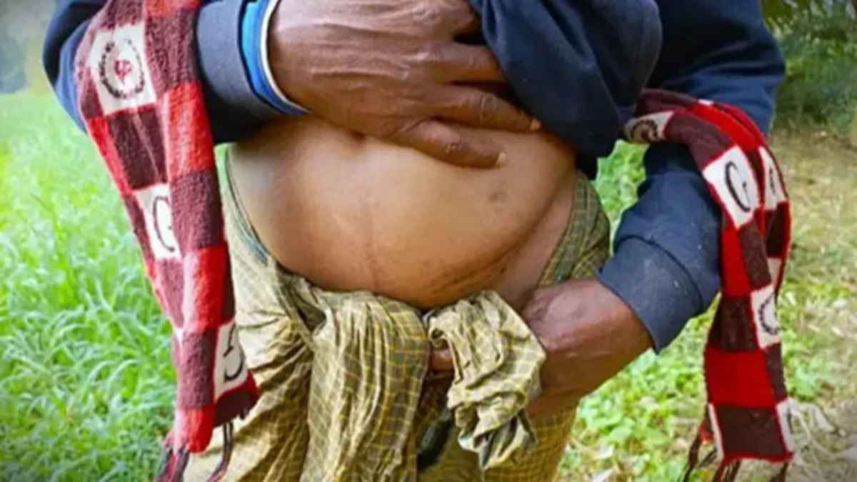 बांग्लादेशी युवाओं के साथ पाकिस्तान में खौफनाक खेल: नौकरी का झांसा देकर निकाली जा रही किडनी, HIV संक्रमित करने की बड़ी साजिश illegal-organ-harvesting